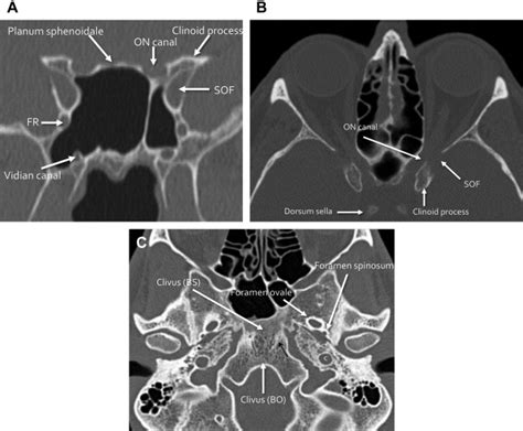 Skull Base Fractures and Their Complications | Radiology Key