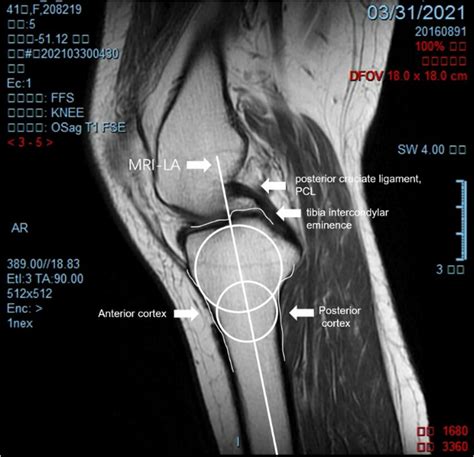 The MRI-LA in the figure is the tibial anatomical axis we need ...