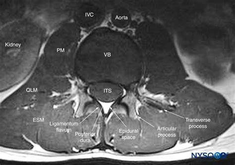 Spinal Sonography and Applications of Ultrasound for Central Neuraxial Blocks - NYSORA