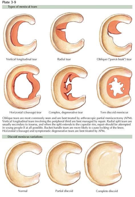 MENISCAL VARIATIONS AND TEARS - pediagenosis