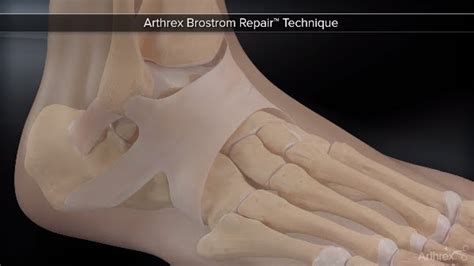 Arthrex Brostrom Repair™ - YouTube