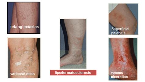 Venous reflux disease pictures | Symptoms and pictures