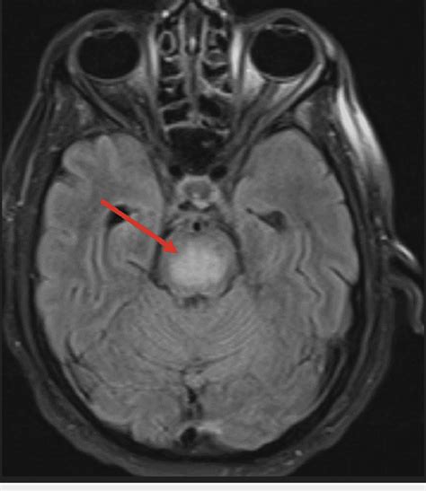 Brain MRI FLAIR sequence showing CPM in a patient with GAD antibody ...