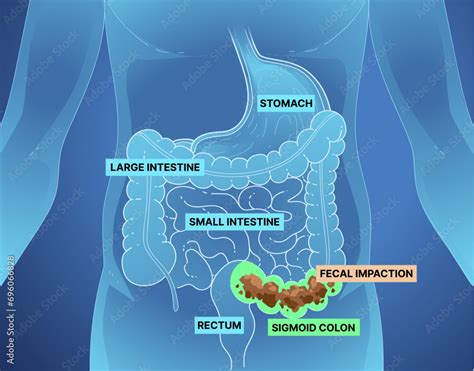 Bowel obstruction. Infographic. Healthcare illustration. Vector illustration. Stock Vector ...