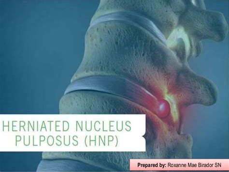 Herniated Nucleus Pulposus