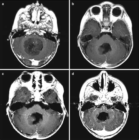 Treatment of Medulloblastoma: Chemotherapy | Neupsy Key