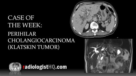 Case of the Week: Perihilar Cholangiocarcinoma/Klatskin Tumor (CT & MRI ...