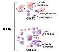 Abnormal Pap Test Results: Kimmel Cancer Center