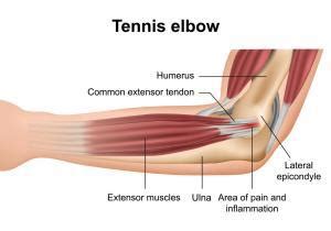 Elbow Tendon Pain - JOI Jacksonville Orthopaedic Institute