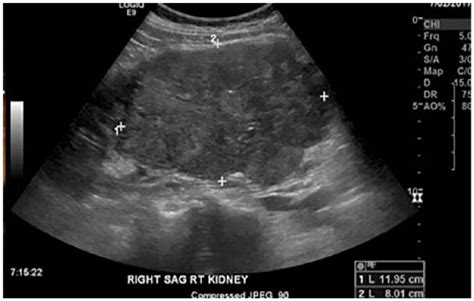 Kidney Tumor Ultrasound