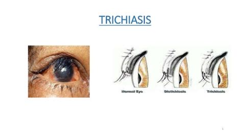 Trichiasis