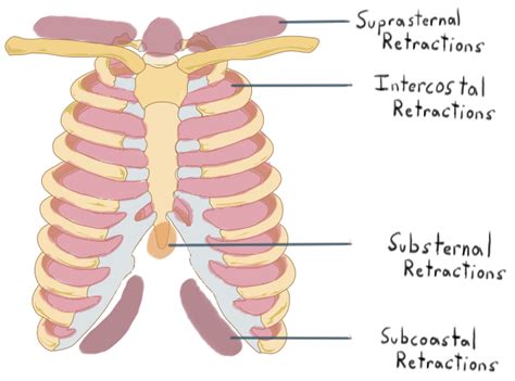 Respiratory distress | Pulmonary Diseases | Khan Academy