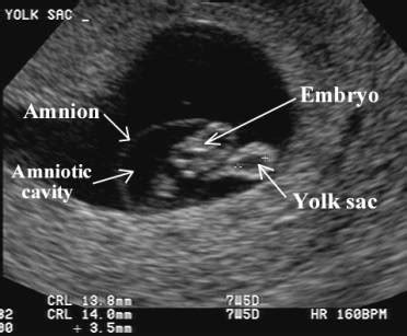 Amniotic Sac Ultrasound