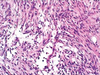 Fibrous Papule Histology