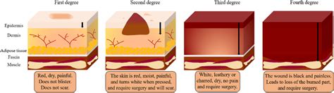 Burn depth. First-degree (superficial thickness, affecting the ...