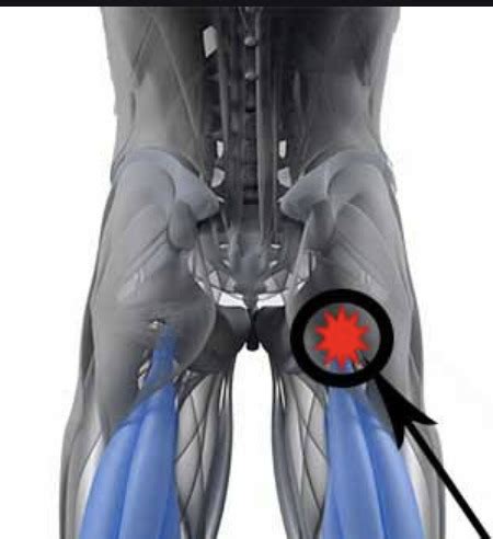 Ischial bursitis: Ischiogluteal pain - Dr. Justin Dean