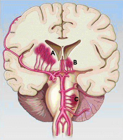 Lacunar Stroke