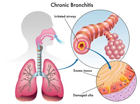 Wonderful Info About How To Deal With Bronchitis - Matehope54