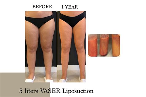 Lipedema | Before & After