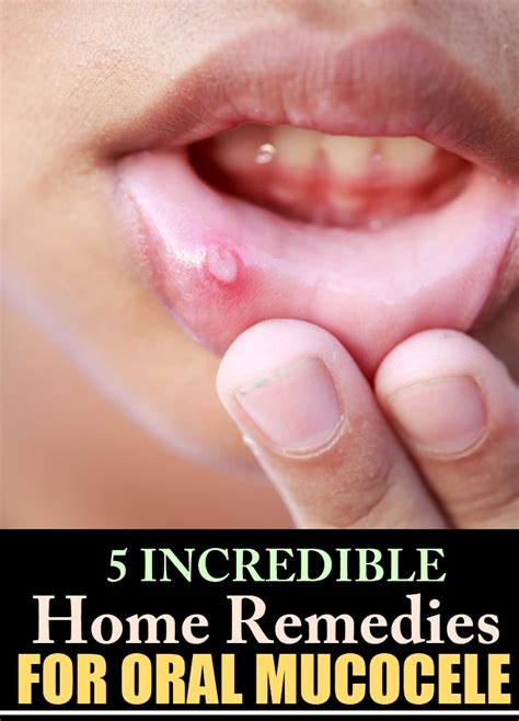 5 Incredible Home Remedies For Oral Mucocele | Natural Home Remedies & Supplements