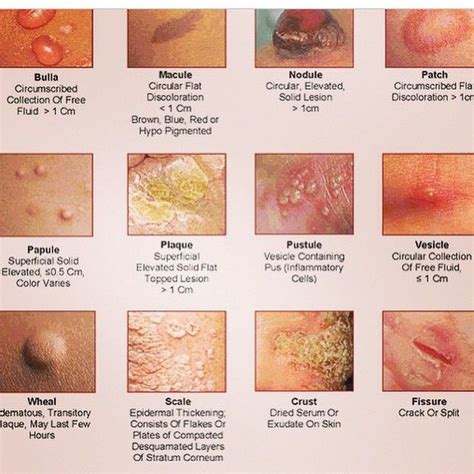 Medical Doctor on Instagram: “Different Skin Rashes #rash #skin #scale #pustule #bulla # ...