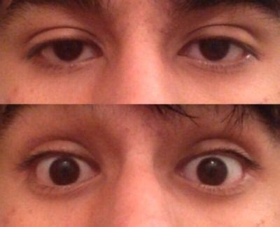 Why does one eye appear smaller than the other? (photos) Doctor Answers, Tips