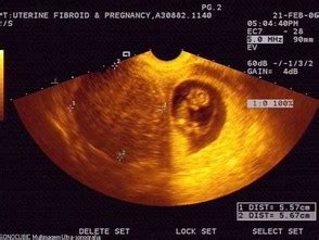 Fibroids & Pregnancy – Fibroid Treatment Collaborative