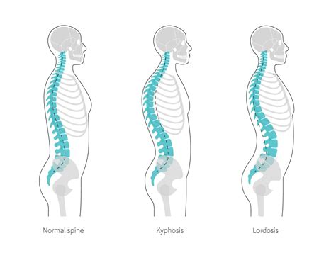 Learning About The Different Spinal Deformity Types Lakewood, CO ...