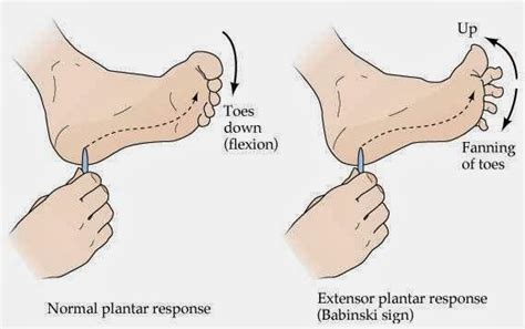 Reflex, babinski; Babinski Reflex; Extensor Plantar Response; Paradoxical Extensor Reflex, Great Toe