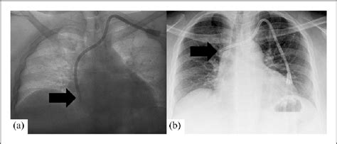 Hemodialysis Catheter Infection | Semantic Scholar