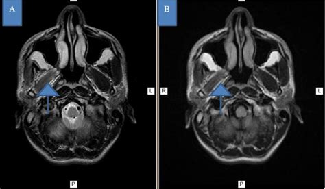 23-year-old immunocompetent male with rhinocerebral mucormycosis ...