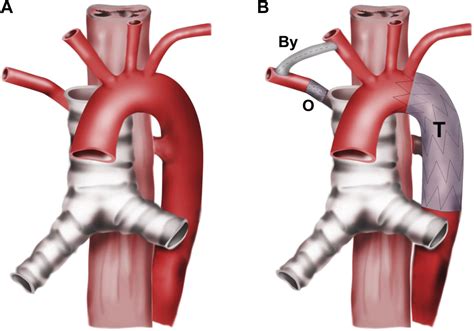 Treatment of Symptomatic Aberrant Subclavian Arteries - European ...