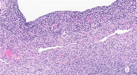 Ovarian Cust Anatomy