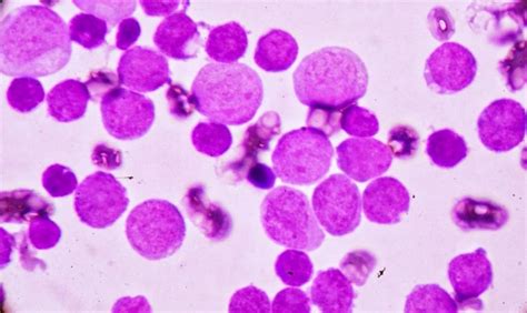 Causes and Treatment of Low Lymphocyte Count [Lymphocytopenia]