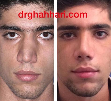 Deviated Septum Before And After (1) » Rhinoplasty: Cost, Pics, Reviews ...