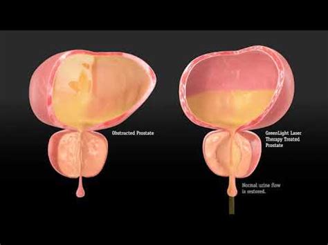 Green Light Laser Prostate Surgery Reviews | Shelly Lighting