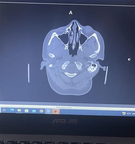 Encephalomalacia? : r/Radiology