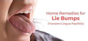 8 Causes & Effective Home Remedies for Lie Bumps (Transient Lingual ...