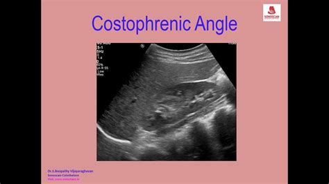 Sonography of Costophrenic Angle - YouTube