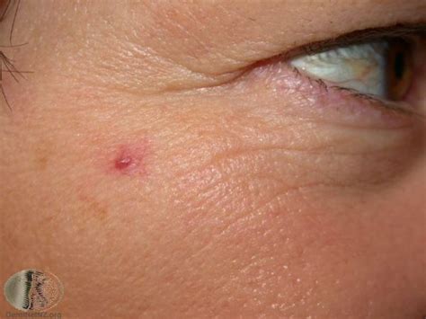 Spider nevus behandling - Oslo Hudlegesenter