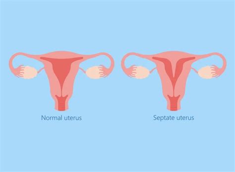 How Rare Is Septate Uterus