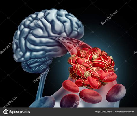 Blood Clot Brain Stock Photo by ©lightsource 166013886