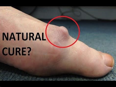 Big Toe Joint Arthritis **Natural Home Treatment TRUTH** - YouTube