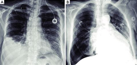 Features of pneumothorax comparing anteroposterior chest X-rays of (A ...