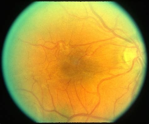 Macular Pucker - Retina Image Bank