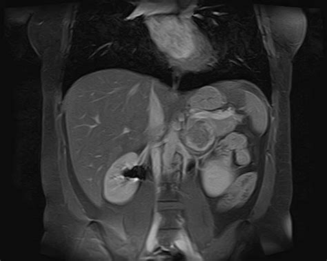 Pheochromocytoma - Body MR Case Studies - CTisus CT Scanning