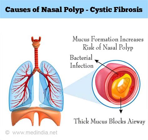 Nasal Polyp - Causes, Symptoms, Diagnosis, Treatment, Health Tips