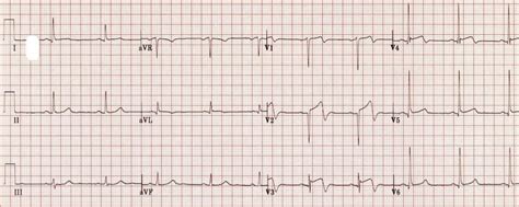 Wellens Syndrome • LITFL • ECG Library Eponym