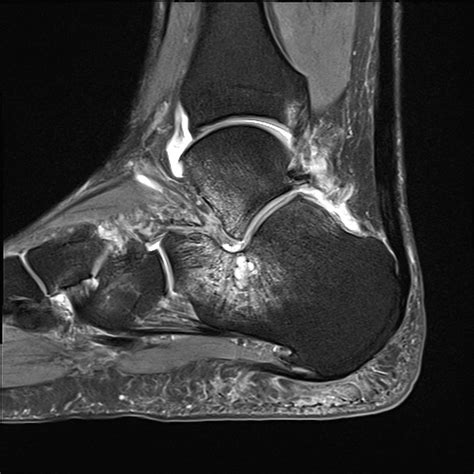 Hallux valgus | Radiology Reference Article | Radiopaedia.org