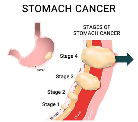 Gastric (Stomach) Cancer: Types, Symptoms, Diagnosis, Treatment - PMCC ...